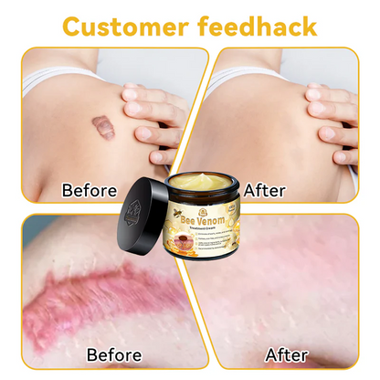 🏆✅Official Store: Turonu™ Aussie Bee Venom Skin Treatment Cream👨‍⚕️Dermatology Experts Approved